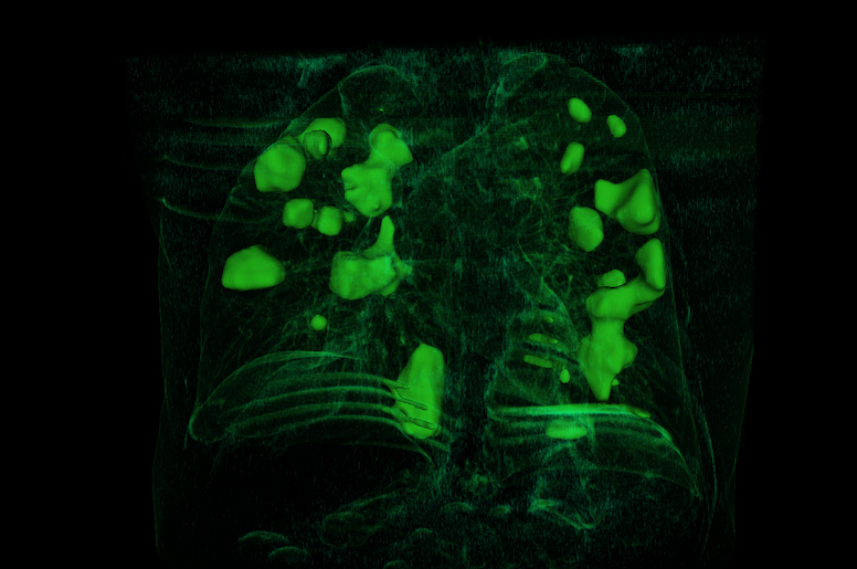 3D rendering of computed tomography image of the lungs of a covid-19 patient. The green solid object